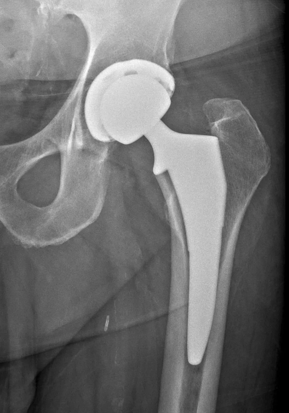 X-ray of an anterior total hip replacement showing the implant in place