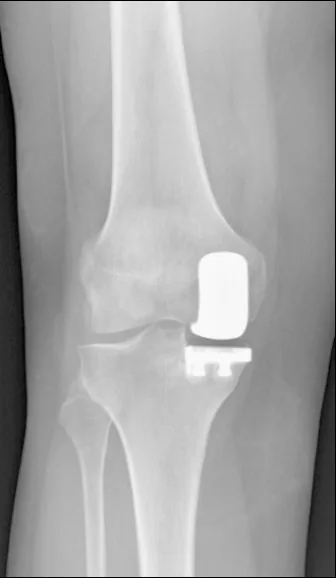 X-ray of a partial (unicompartmental) knee replacement