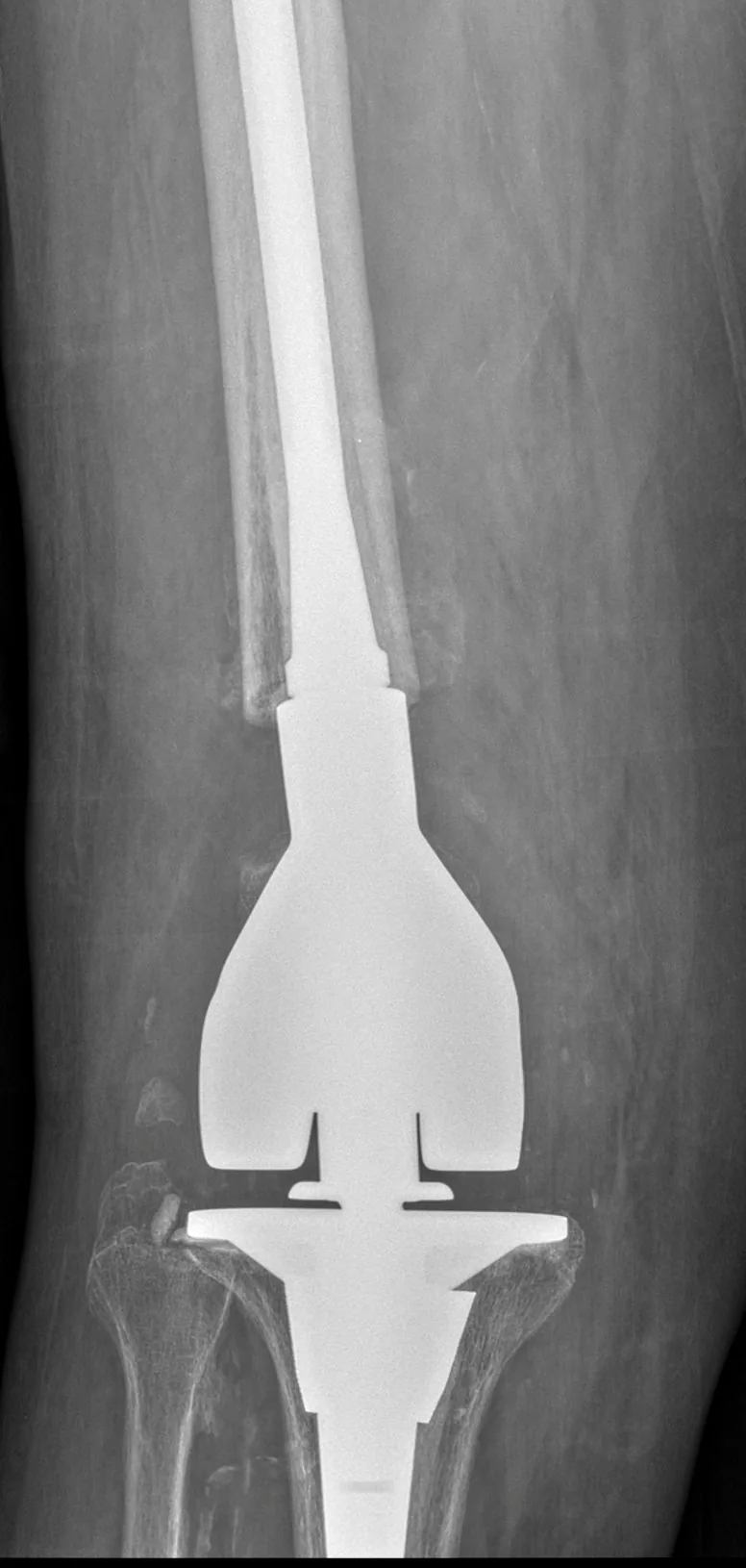 X-ray of a revision hip and knee replacement