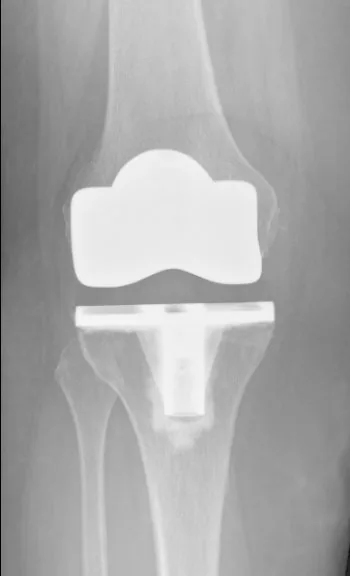 X-ray of a total knee replacement